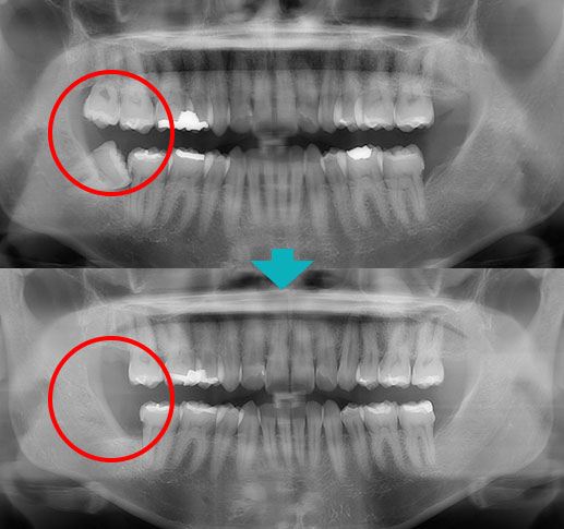 歯科用CTによる「3次元精密診断