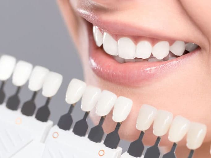 歯を傷つけずに化学的に白さを改善するホワイトニング